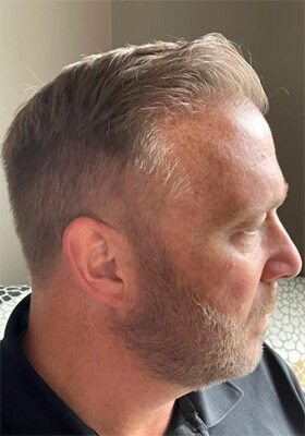 hair transplant photos