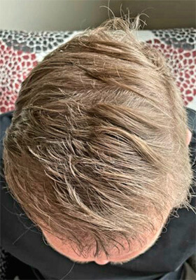 hair transplant before after Photos