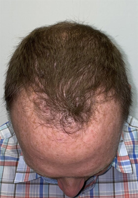 hair transplant before after Photos