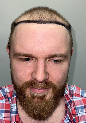 hair transplant photos