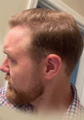 hair transplant photos