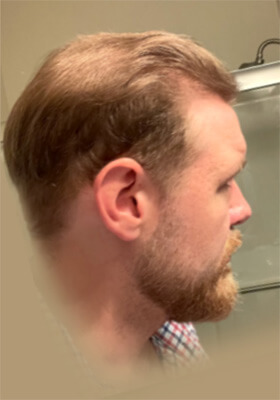 hair transplant photos