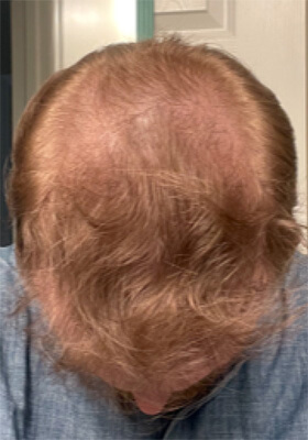 hair transplant before after Photos