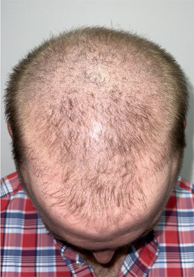 hair transplant before after Photos