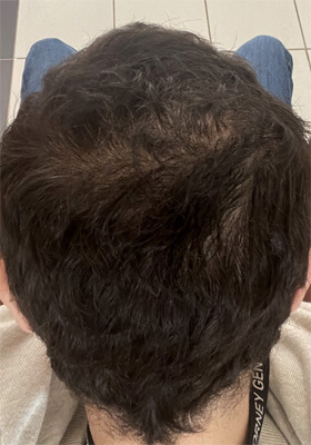 hair transplant photos