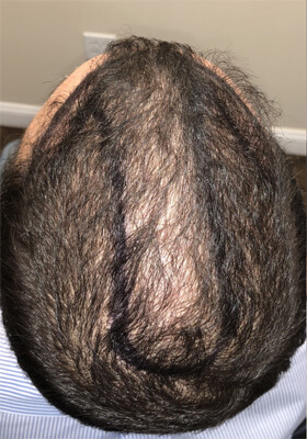 hair transplant before after Photos