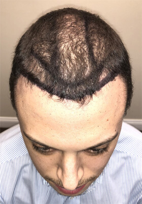 hair transplant before after Photos