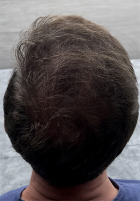 hair transplant photos