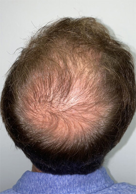 hair transplant photos