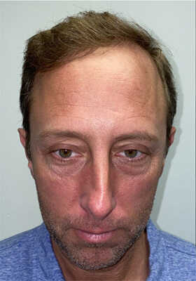 hair transplant photos