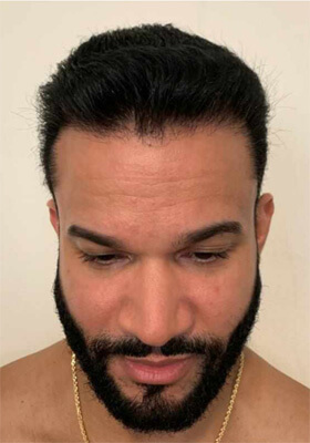 hair transplant before after Photos