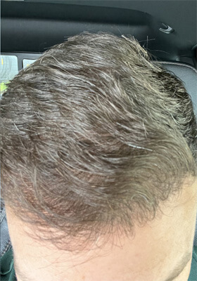 hair transplant photos