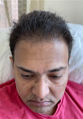 hair transplant photos