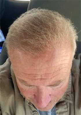 hair transplant photos