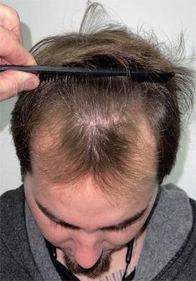 hair transplant before after Photos