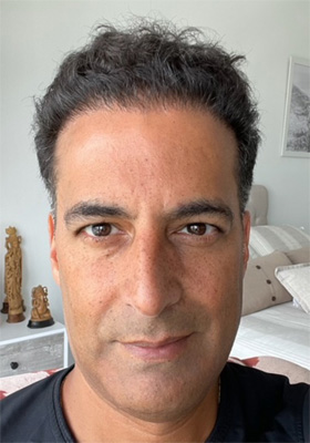 hair transplant photos