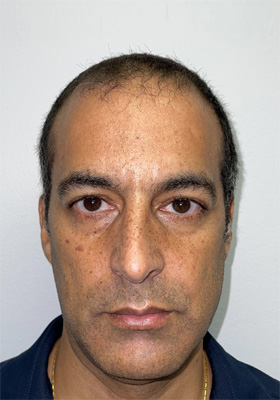 hair transplant photos