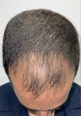 hair transplant before after Photos