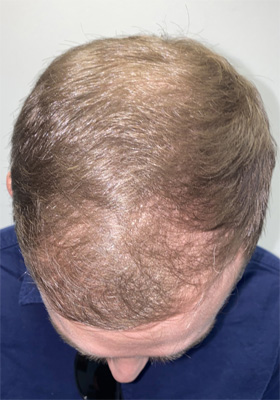 hair transplant before after Photos