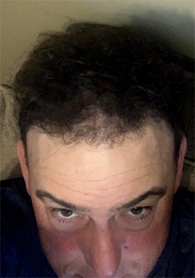 hair transplant before after Photos