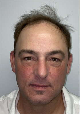 hair transplant before after Photos