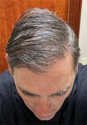 hair transplant photos