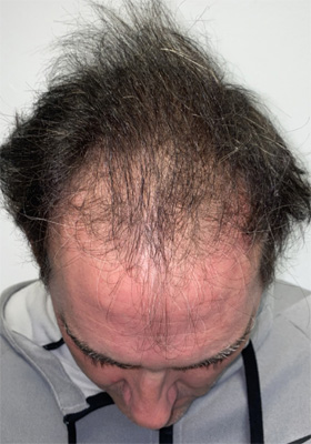 hair transplant photos