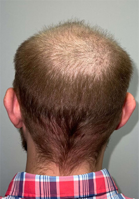 hair transplant photos