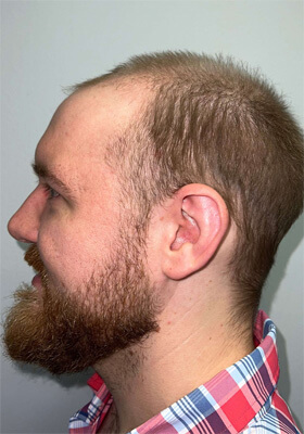 hair transplant photos