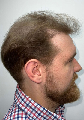 hair transplant photos