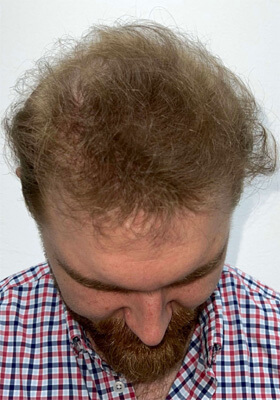 hair transplant before after Photos