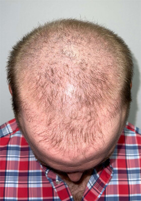 hair transplant before after Photos