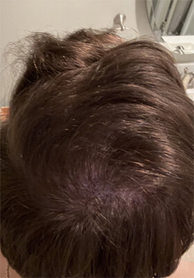 hair transplant photos