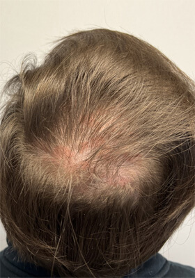 hair transplant photos