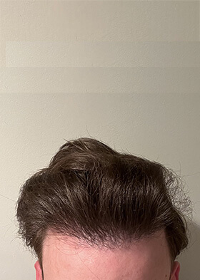 hair transplant photos