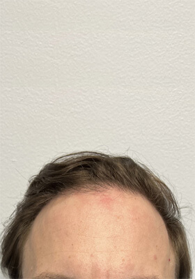 hair transplant photos