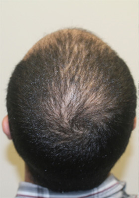 hair transplant photos