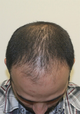 hair transplant before after Photos