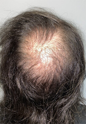 hair transplant before after Photos