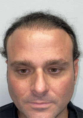 hair transplant photos