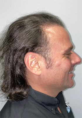 hair transplant photos