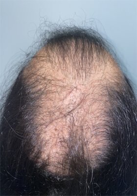 hair transplant photos