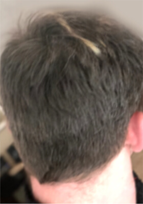 hair transplant photos