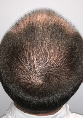 hair transplant photos