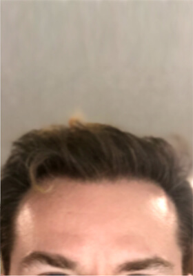 hair transplant before after Photos