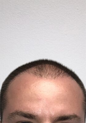 hair transplant photos