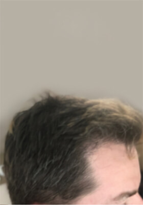 hair transplant photos