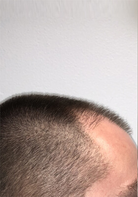 hair transplant photos