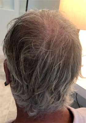 hair transplant photos