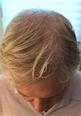 hair transplant photos